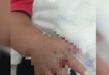 Bebê de 1 ano é transferido para Manaus após ser picado por cobra na zona rural de Maués